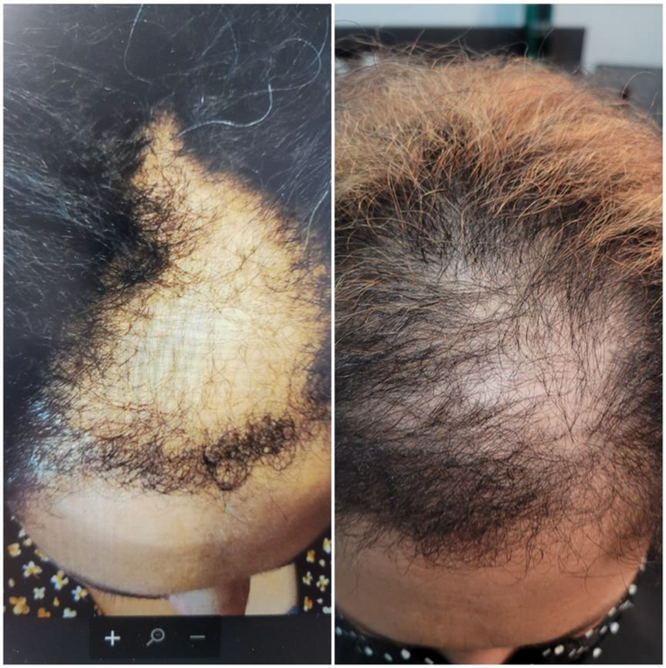 Topic and Laser Treatment 2 Months