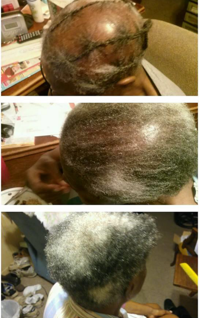 Topic and Laser Treatment 4 Months